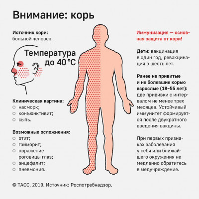 Корь - вирусное заболевание с воздушно-капельным путем передачи.